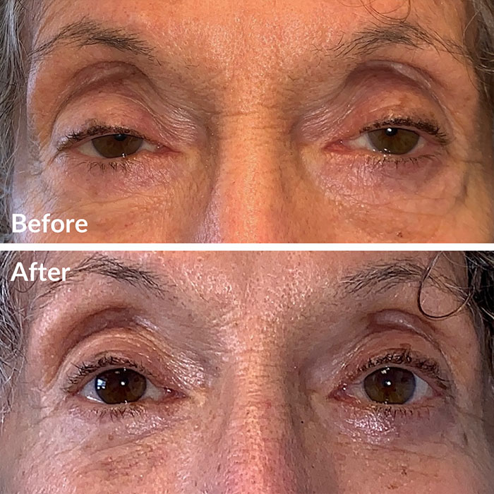Before and after photos of lower blepharoplasty at Lunata in the Bay Area.