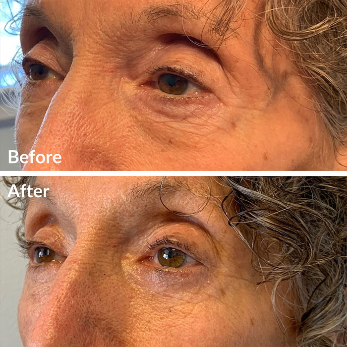 Before and after photos of lower blepharoplasty at Lunata in the Bay Area.