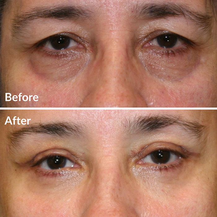 Before and after photo of facial fat transfer at Lunata in Berkeley.