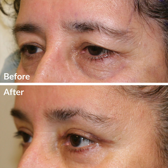 Before and after photo of facial fat transfer at Lunata in Berkeley.