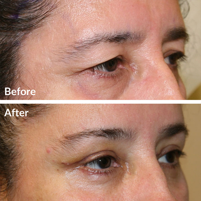Before and after photo of facial fat transfer at Lunata in the Bay Area.