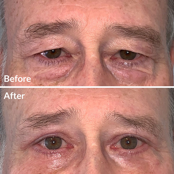Before and after photo of a man who received upper blepharoplasty at Lunata in the Bay Area.