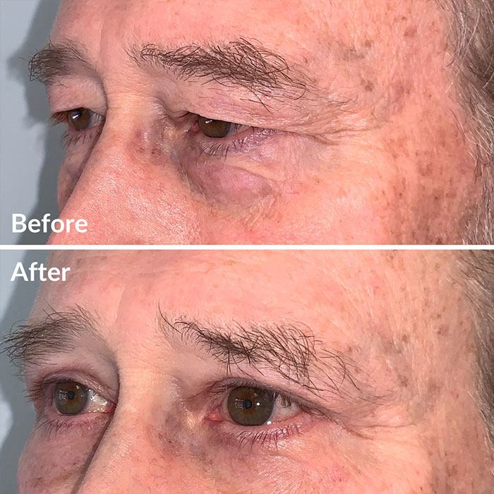 Before and after photo of a man who received upper blepharoplasty at Lunata in Berkeley.